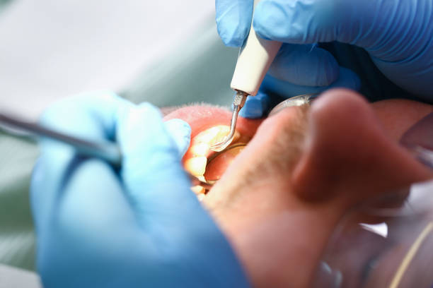 Best Emergency Dental Extractions in Lakewood, CO